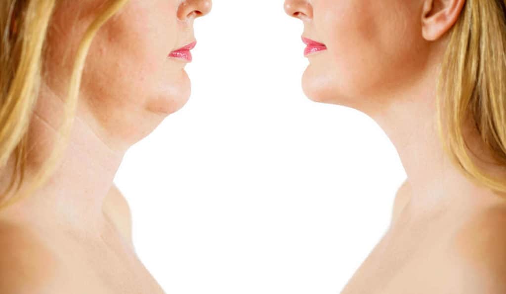 Double Chin treatment Stockton-on-Tees before and after results