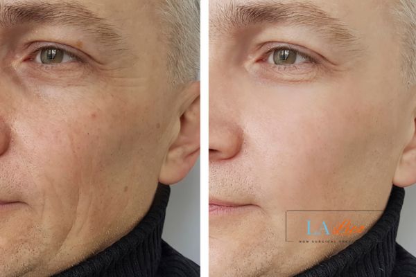 See the amazing results of Morpheus8 Treatment Stockton-on-Tees!